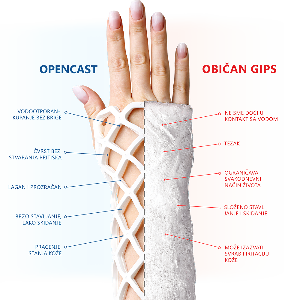 Běžná sádra vs OPEN CAST